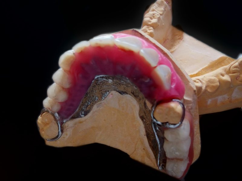 CoCr partial denture with teeth set in wax
